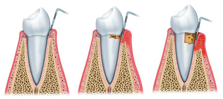 periodontal gum disease